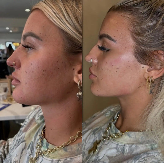What Is XERF and How Does It Tighten Skin?